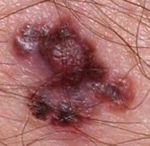 The ABCDE of melanoma rule (below) will help you and your workforce to remember what to look out for - the example photographs show abnormal moles