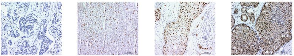 1570 A B C D Figure 1. Expression analysis of ERβ in breast cancer tissues using immunohistochemistry (magnification, x100).