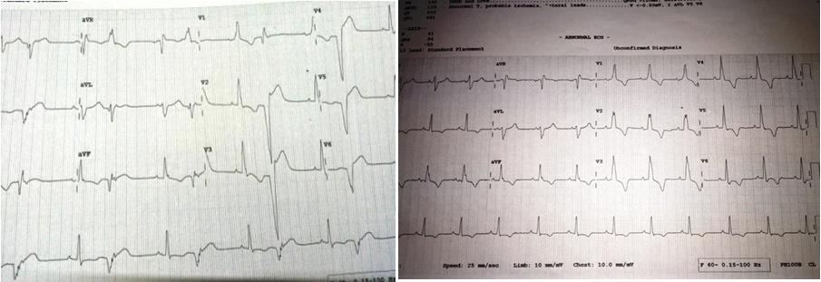 107 Figure 1: Resting 12 lead Electrocardiogram showing RBBB with generalized T wave inversion & ventricular bigeminy. Figure 2: Holter strip showing ventricular run.