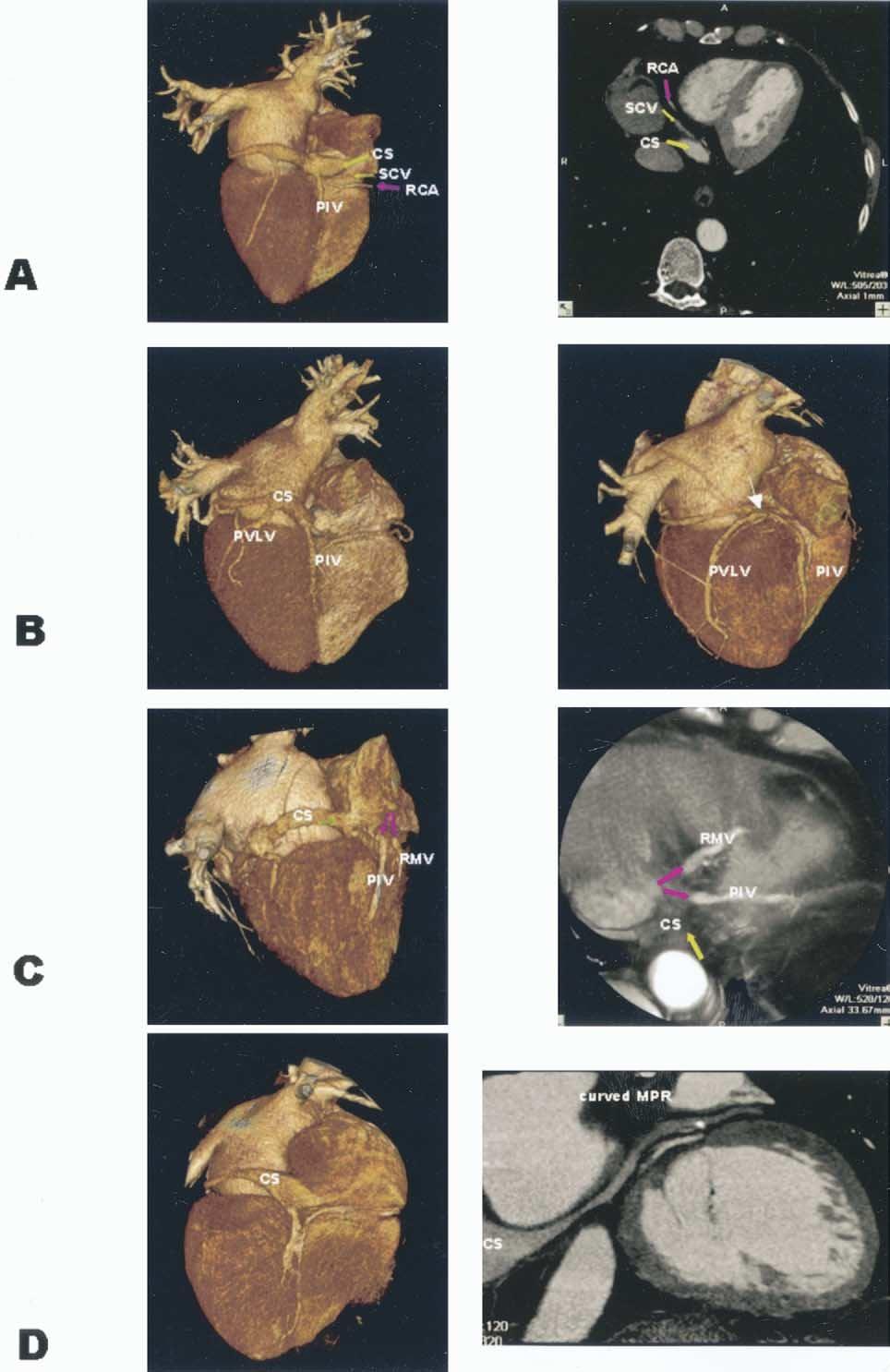 752 Jongbloed et al. JACC Vol. 45, No. 5, 2005 CT Imaging of the Cardiac Venous System March 1, 2005:749 53 Figure 2. (A) Variant 1. Left volume-rendered reconstruction.