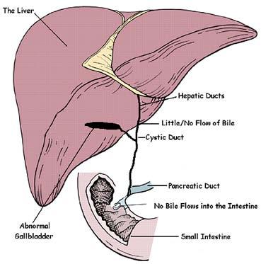 In healthy babies, bile ducts carry bile from the liver to the gallbladder and eventually to the small intestine. Bile includes chemicals that the body is trying to get rid of.