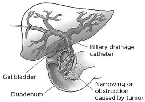 Types of drainage: External-biliary-drainage - this catheter passes through the skin and into the bile ducts. The end of the catheter that is in the bile ducts is placed above the blockage (figure 2).