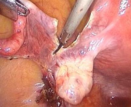 Even when the surgical excision includes the removal of the mesosalpinx, salpingectomy does not damage the ovarian reserve.