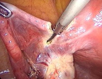 A demonstration of the absence of any detrimental effects of the radicalization of the currently practiced standard technique for salpingectomy represents a new