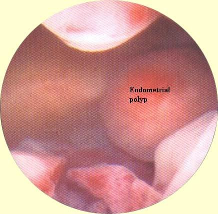 Endometrial