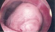 Larger submucous fibroids 204 women with unexplained infertility and submucous fibroids randomised to either 101 hysteroscopic 103