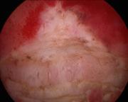 Uterine septum resection Mollo et al, 2009 Fertil Steril Controlled study showed higher