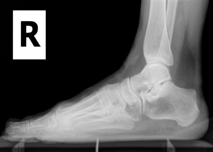 Discussion Hallux abducto valgus can be a debilitating condition for the active patient and can pose a challenge to the surgeon.