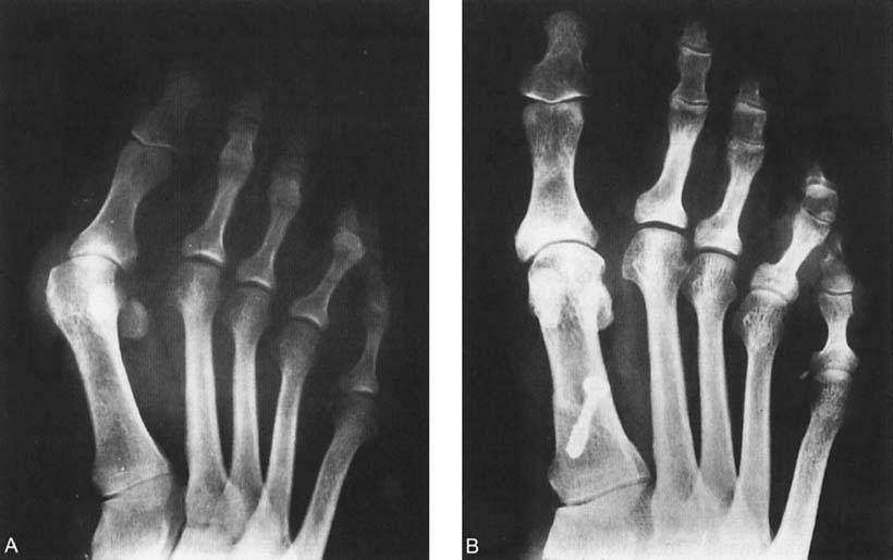 192 Zernbsch et al Clinical Orthopaedics and Related Research ternative procedures, such as metatarsal osteotomies, because Keller's operation cannot be expected to relieve metatar~algia.