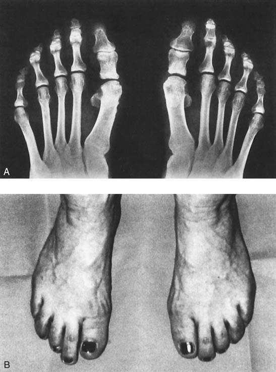 Number 376 July, 2000 Correction of Hallux Valgus 193 Fig 3A-B.