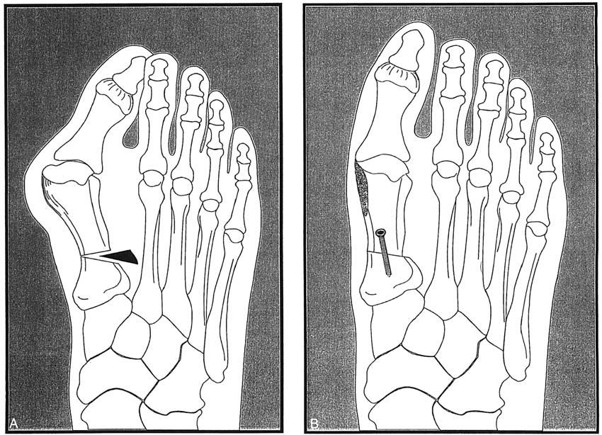 186 Zembsch et al Clinical Orthopaedics and Related Research Fig 1A-6. (A) Removal of a laterally based wedge. (B) Fixation of the osteotomy with a cancellous screw.