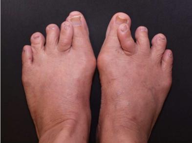 Figure 1: Pre-operativephoto showing bilateral overlapping deformity formed by hallux valgus and second toe varus deformities. [6].