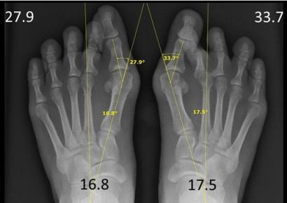The purpose of this presentation was to report the unexpected spontaneous realignment of second toes and its metatarsophalangeal joint (MPJ) once the underlying severe MPV deformities were c o r