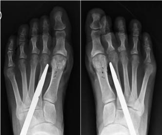 A 60-year-old female had progressive HV and bunion deformities for many years.