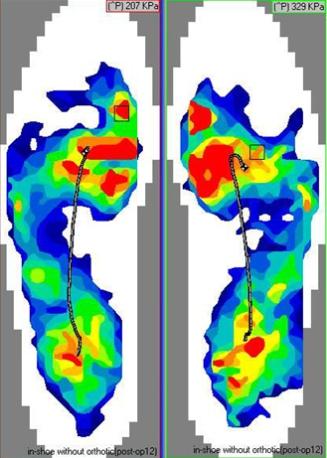 Pre-operative walking plantar pressure study by F-Scan (Tekscan, USA) (Fig.