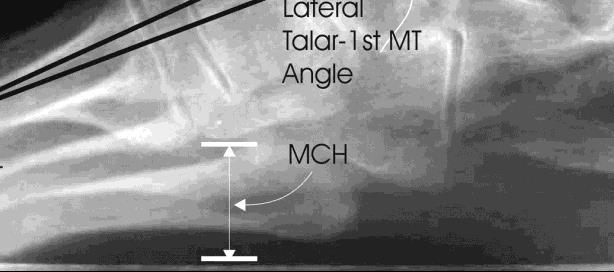 Materials & Method Radiologic parameters assessment 1. The length of 1 st ray on standing AP/lateral images 2. Medial cuneiform height (MCH) on standing lateral images 3.