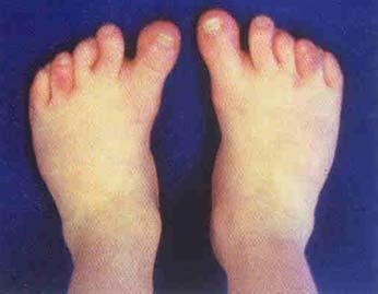 Skewfoot Z-foot, serpentine foot a spectrum of complex deformity
