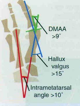 Hallux Valgus ( Bunion ) AP & lateral standing radiographs