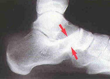 hindfoot : oblique X-ray X - best lateral X-ray X - anteater
