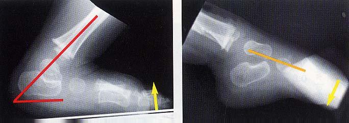 Flat Feet ( Pes Planus ) Vertical Talus flexible oblique talus : lateral flexion and extension X-ray X