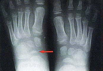 Osteochondritis Köhler disease tarsal navicular avascular necrosis most common in boys between 3 and 5 years of age spontaneous healing