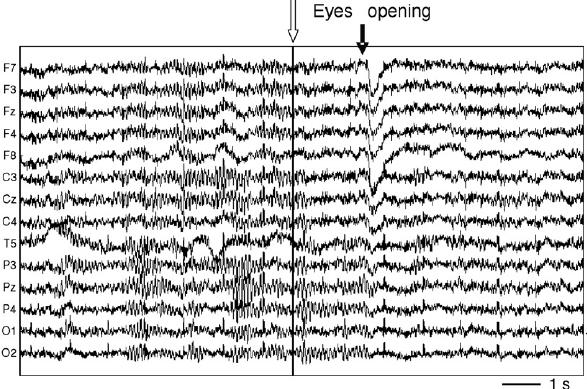 Human EEG showing
