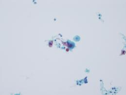 2014 RADIATION-ASSOCIATED CHANGES 56 y old w RT for cervix Ca in 1999 We have her smears with such cells since 2007 No gross/
