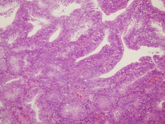 Endometrioid carcinoma FIGO Grade I ENDOMETRIAL CELLS - Benign-appearing Normal finding in reproductive age Common in menses and proliferative phase Considered as abnormal in postmenapusal women