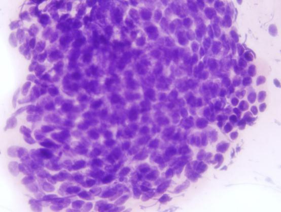 normal endometrial cells Mild hyperchromasia Chromatin heterogeneity Occasional