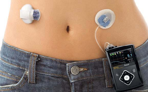 When poor control persists on insulin pump therapy