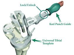 Universal Tibial Template and Keel Punch Guide Assembly: > Ensure that the handle of the Keel Punch Guide is unlocked pull