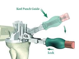 Assembly Instructions > Assemble the Keel Punch Guide to the Universal Tibial Template by inserting the Keel Punch Guide, at
