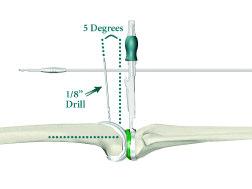 Instrument Bar See Catalog PS Femoral Trial See Catalog CR Femoral Trial Figure 41 > Once the appropriate size is chosen, two methods of rotational alignment can be utilized.