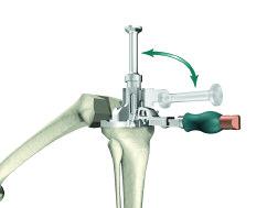 Triathlon Knee System Anterior Referencing Surgical Protocol > Once the desired depth is achieved, the keel punch guide handle is lifted up and rotated anteriorly.