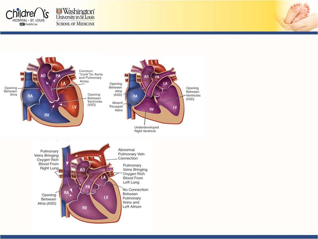 Critical CHD Lesions *D-Transposition of the great arteries *Tetralogy of Fallot