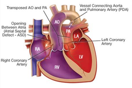 anomalous pulmonary venous return *Pulmonary atresia/intact ventricular septum
