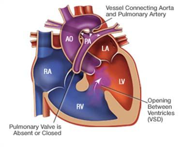 Ductus Arteriosus in CCHD May provide pulmonary blood flow (e.g.