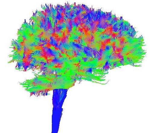 Tractography IFOF