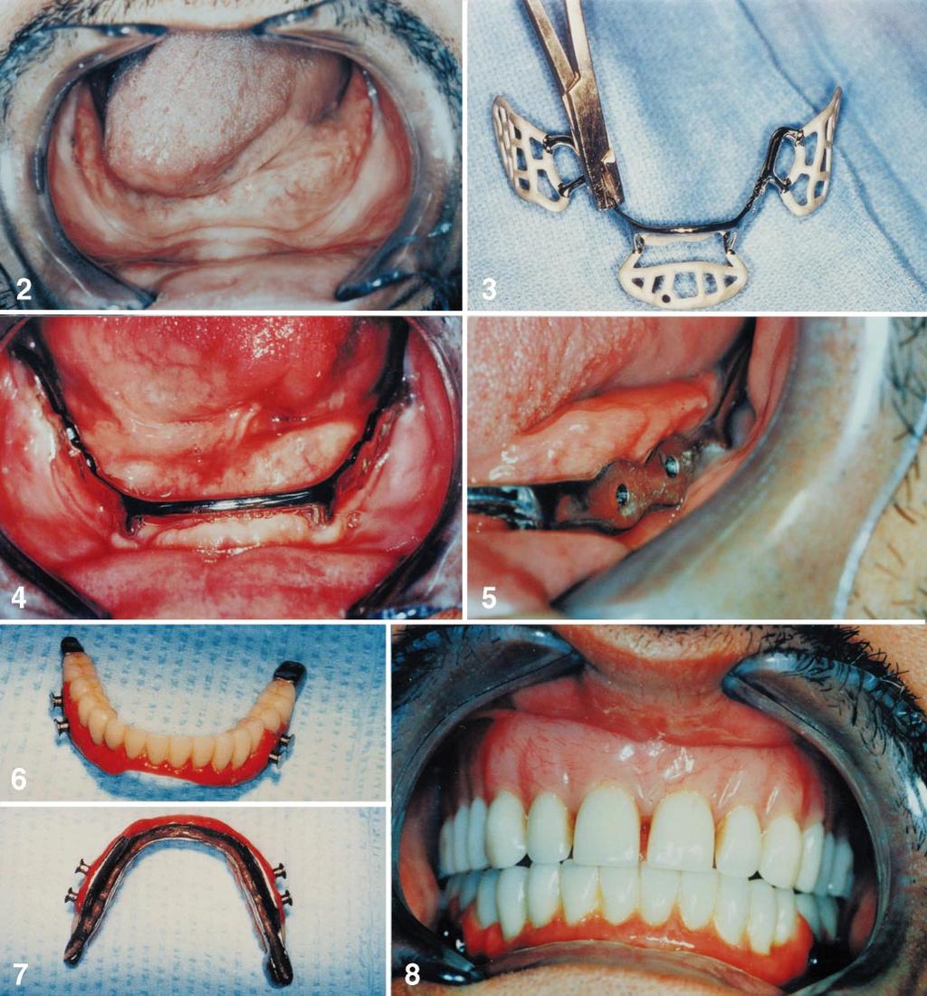 LEW ATTACHMENT: CLINICAL REPORTS FIGURE 2. Preoperative intraoral view of mandibular arch. FIGURE 3. Tripodal subperiosteal implant before insertion. FIGURE 4.