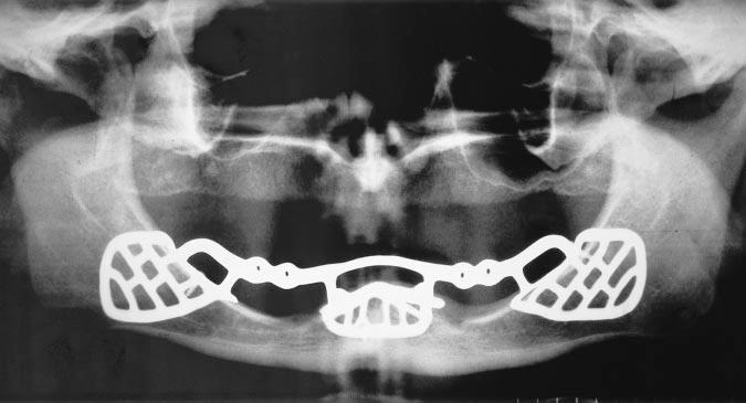 Jack Piermatti, Sheldon Winkler FIGURE 9. Panoramic radiograph of subperiosteal implant. Note the bilateral recesses to accommodate Lew attachments. FIGURE 10.
