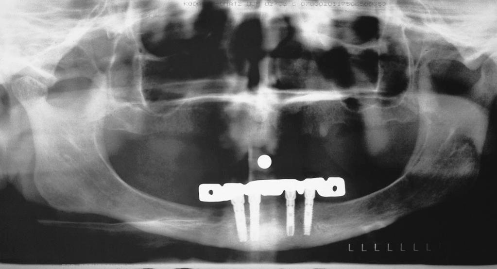 Jack Piermatti, Sheldon Winkler FIGURE 14. Postoperative radiograph showing 4 endosteal implants and implant connecting bar in place. FIGURE 15.