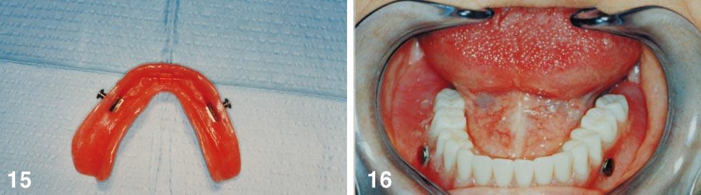 Intraoral view of mandibular overdenture with bilaterally placed Lew attachments in closed positions.