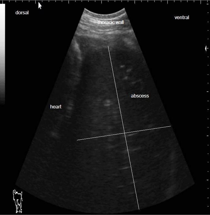 large sized abscess (20 cm) with