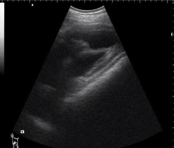 Heart S V Re Ultrasonogram of diaphragmatic hernia imaged at 4th ICS