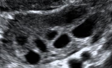 follicles (2-10 mm) /ovary Range