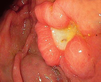 THE SURPRISING TRUTH ABOUT ULCERS Ulcers are sores inside or outside of the body Example of a stomach ulcer.