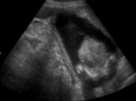 Suspicious for Malignancy 21 weeks pregnant LOOK SPECIFIC FEATURE: FAT Interim growth 8 months from 3 to 5.