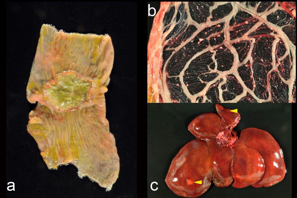 Grandt et al 3 Figure 3 (a) Ulcerated exophytic neoplasia of the colonic wall. (b) Abundant transplantational metastases within the omentum.