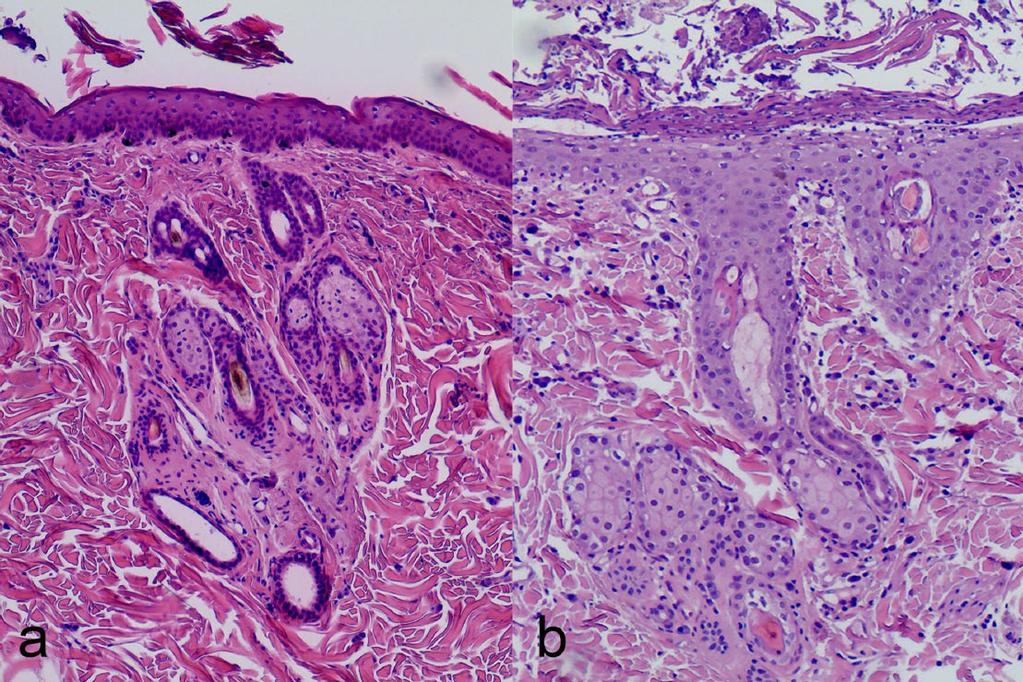 Haematoxylin and eosin ( 20) Figure 5 Colon: in the upper left corner ulceration of the mucosa and transmural infiltration with neoplastic cells and desmoplastic response.