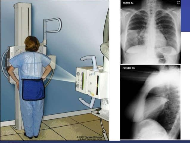Chest X-ray exam Fast and painless imaging test using x-rays.